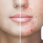Your Complete Guide to Adult Acne
